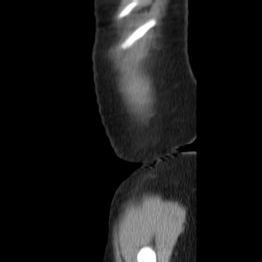 Autosomal dominant polycystic kidney disease (Radiopaedia 23061-23093 F 55).jpg