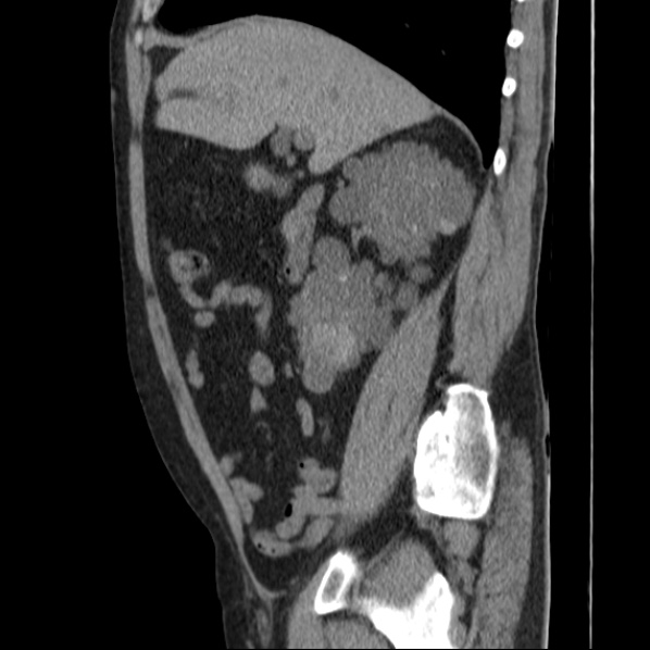 File:Autosomal dominant polycystic kidney disease (Radiopaedia 36539-38101 D 31).jpg