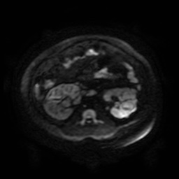 Autosomal dominant polycystic kidney disease (Radiopaedia 50259-55611 Axial DWI 97).jpg