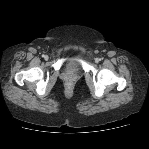 File:Autosomal dominant polycystic kidney disease with hepatic involvement (Radiopaedia 32693-33662 B 81).jpg