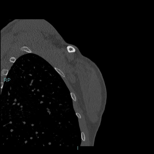 Avascular necrosis after fracture dislocations of the proximal humerus (Radiopaedia 88078-104655 Coronal bone window 130).jpg