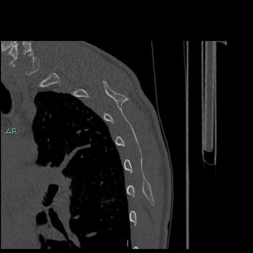 Avascular necrosis after fracture dislocations of the proximal humerus (Radiopaedia 88078-104655 Sagittal bone window 76).jpg