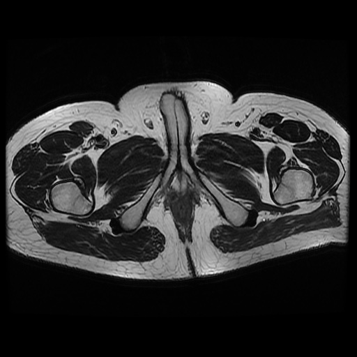 File:Avascular necrosis of the hip (Radiopaedia 61503-69465 T2 26).jpg