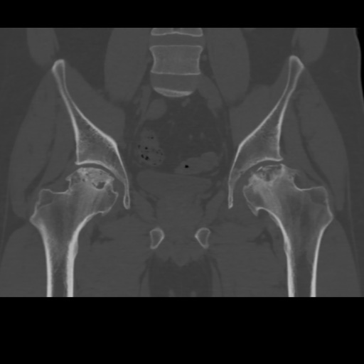 File:Avascular necrosis of the hip (Radiopaedia 61503-69467 Coronal bone window 16).jpg