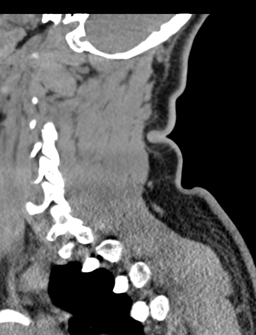 Axis peg fracture (type 3) and atlas lateral mass (type 4) fracture (Radiopaedia 37474-39324 D 56).png