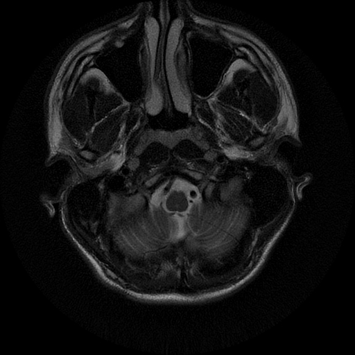 File:Azygos anterior cerebral artery (Radiopaedia 17059-16756 Axial T2 23).jpg