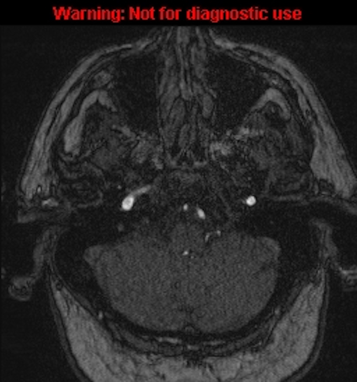 Azygos anterior cerebral artery (Radiopaedia 59325-66677 Axial MRA 22).jpg