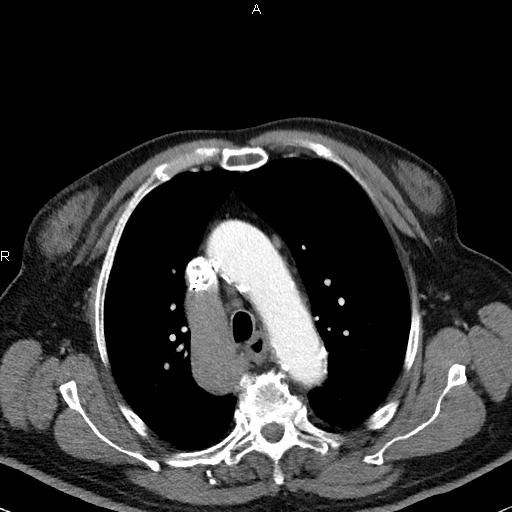 File:Azygos continuation of the inferior vena cava (Radiopaedia 18537-18404 C+ arterial phase 19).jpg