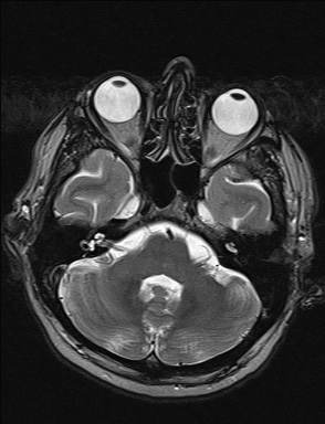 File:Balo concentric sclerosis (Radiopaedia 50458-55940 Axial T2 34).jpg