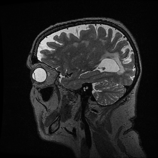 Balo concentric sclerosis (Radiopaedia 53875-59982 Sagittal 3D FSE 82).jpg