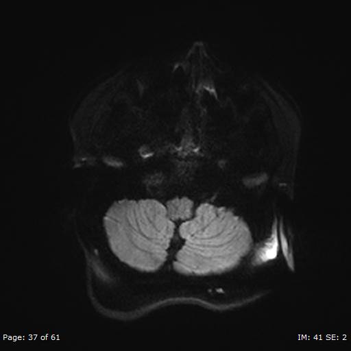 Balo concentric sclerosis (Radiopaedia 61637-69636 Axial DWI 37).jpg