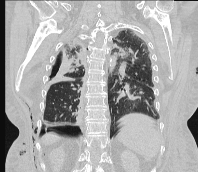 Barotrauma due to mechanical ventilation (Radiopaedia 28079-28336 Coronal lung window 70).jpg