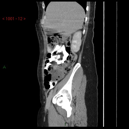 File:Bartholin gland cyst (Radiopaedia 54904-61181 Sagittal C+ delayed 12).jpg