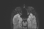 File:Basal cell carcinoma - nasal region (Radiopaedia 70292-80365 Axial DWI 19).jpg