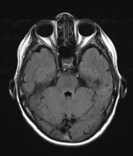 File:Base of skull chondrosarcoma (Radiopaedia 30410-31070 Axial FLAIR 7).jpg