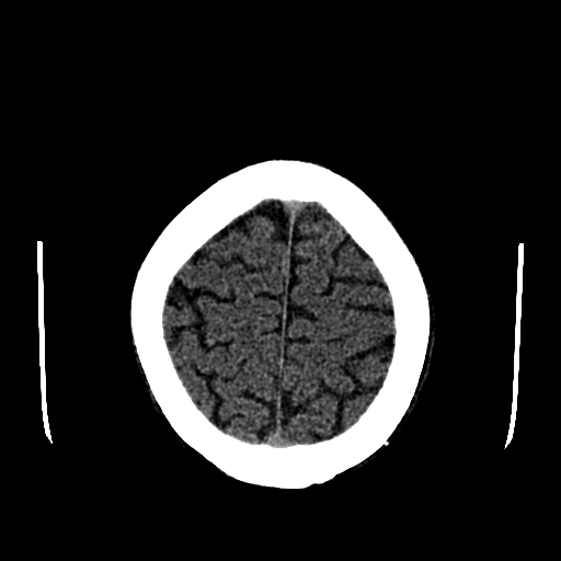 File:Basilar artery perforator aneurysm (Radiopaedia 82455-96597 Axial non-contrast 29).jpg
