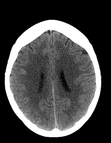 File:Basilar tip aneurysm with coiling (Radiopaedia 53912-60033 Axial 6).jpg