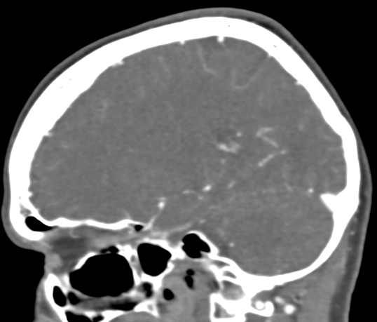 Basilar tip aneurysm with coiling (Radiopaedia 53912-60086 C 47).jpg