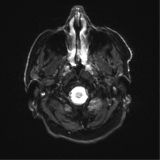 File:Behavioral variant frontotemporal dementia and late onset schizophrenia (Radiopaedia 52197-58083 Axial DTI Trace W 2).png