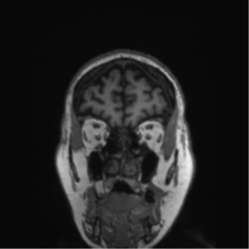 Behavioral variant frontotemporal dementia and late onset schizophrenia (Radiopaedia 52197-58083 Coronal T1 76).png