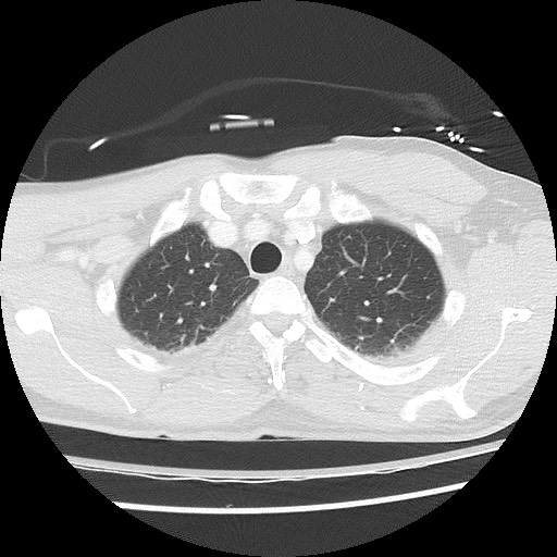 Benign post-traumatic pseudopneumoperitoneum (Radiopaedia 71199-81495 Axial lung window 21).jpg