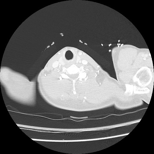 Benign post-traumatic pseudopneumoperitoneum (Radiopaedia 71199-81495 Axial lung window 4).jpg