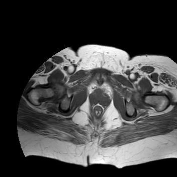 File:Benign seromucinous cystadenoma of the ovary (Radiopaedia 71065-81300 Axial T1 2).jpg