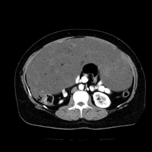 Benign spindle cell tumor - abdominopelvic (Radiopaedia 61300-69212 A 29).jpg