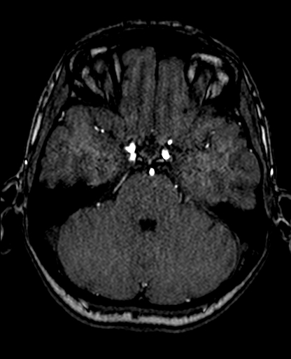 File:Berry aneurysm of the terminal internal carotid artery (Radiopaedia 88286-104918 Axial TOF 88).jpg