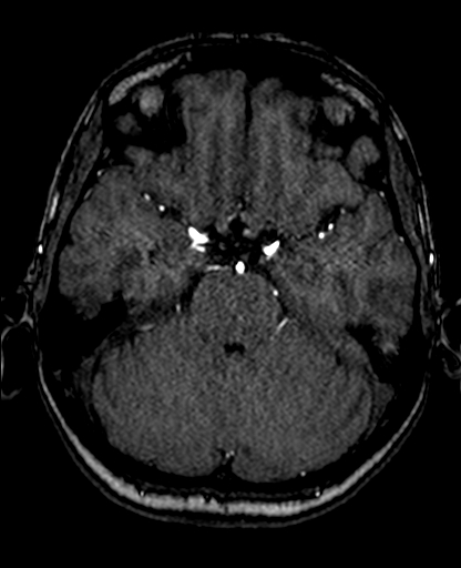 Berry aneurysm of the terminal internal carotid artery (Radiopaedia 88286-104918 Axial TOF 92).jpg