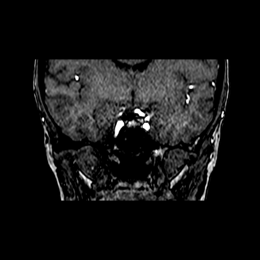 Berry aneurysm of the terminal internal carotid artery (Radiopaedia 88286-104918 Coronal TOF 42).jpg