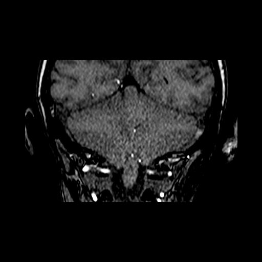 File:Berry aneurysm of the terminal internal carotid artery (Radiopaedia 88286-104918 Coronal TOF 87).jpg