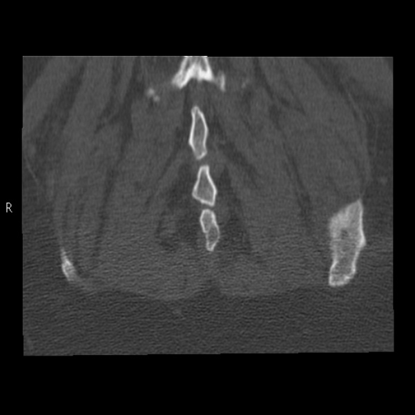 Bertolotti syndrome (Radiopaedia 24864-25128 Coronal bone window 46).jpg