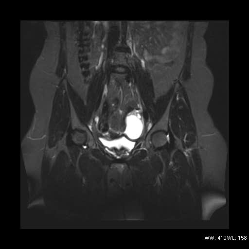 File:Bicornuate uterus- on MRI (Radiopaedia 49206-54297 Coronal STIR 7).jpg