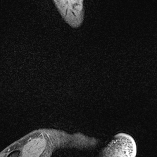 Bilateral Achilles tendon complete tear (Radiopaedia 81344-95051 Sagittal WE - Left 11).jpg
