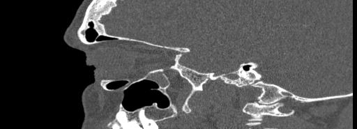 File:Bilateral Ectopic Infraorbital Nerves (Radiopaedia 49006-54084 Sagittal bone window 14).jpg