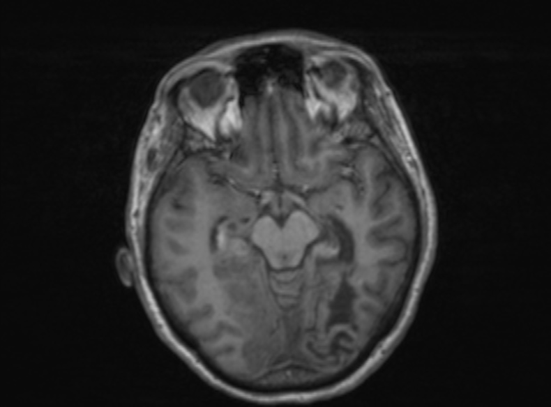 Bilateral PCA territory infarction - different ages (Radiopaedia 46200-51784 Axial T1 263).jpg