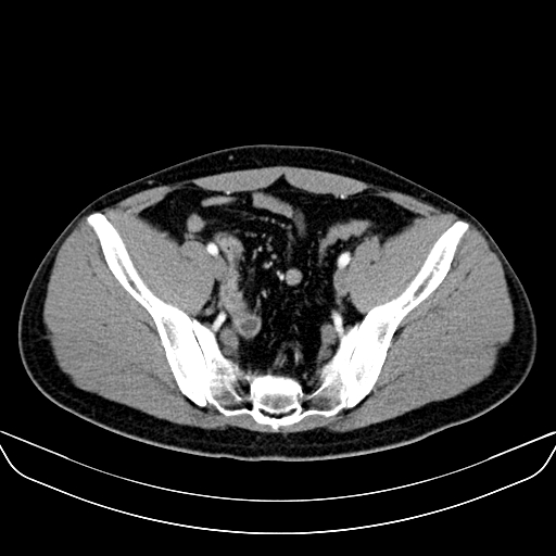 File:Bilateral accessory renal arteries with mild pelvi-ureteric junction (PUJ) obstruction (Radiopaedia 66357-75596 A 57).jpg