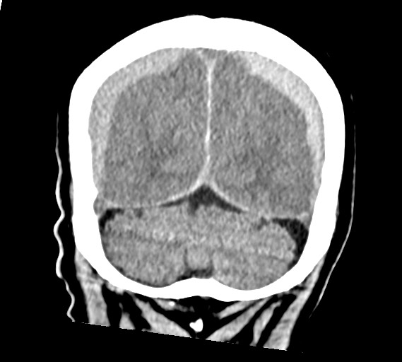 Bilateral acute on chronic subdural hematomas (Radiopaedia 78466-91146 Coronal non-contrast 54).jpg