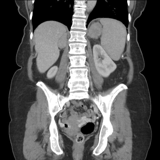 Bilateral adrenal granulocytic sarcomas (chloromas) (Radiopaedia 78375-91007 B 63).jpg