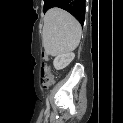 Bilateral adrenal granulocytic sarcomas (chloromas) (Radiopaedia 78375-91007 C 44).jpg