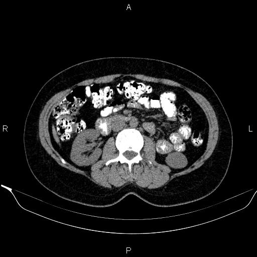 Bilateral adrenal myelolipoma (Radiopaedia 63058-71535 Axial non-contrast 82).jpg