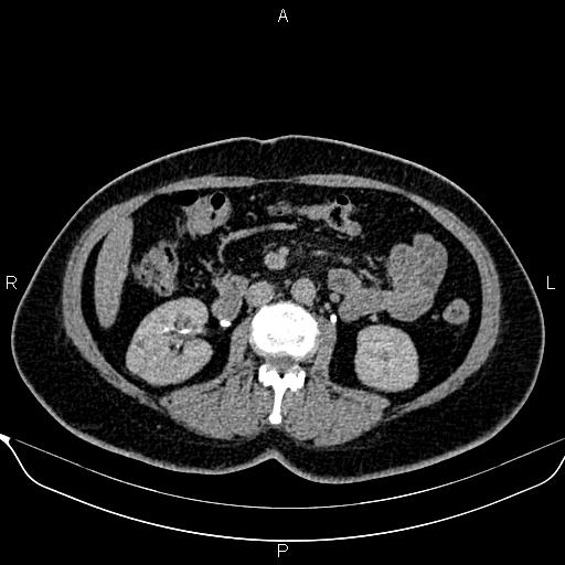 Bilateral benign adrenal adenomas (Radiopaedia 86912-103124 Axial C+ delayed 69).jpg