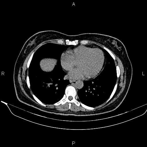 File:Bilateral benign adrenal adenomas (Radiopaedia 86912-103124 Axial non-contrast 9).jpg