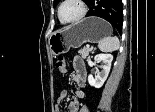 Bilateral benign adrenal adenomas (Radiopaedia 86912-103124 E 70).jpg