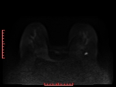 File:Bilateral breast implant rupture (Radiopaedia 24761-25027 DWI 14).jpg