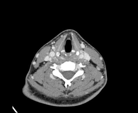Bilateral carotid body tumors (Radiopaedia 61841-69870 Axial Post contrast 70).jpg