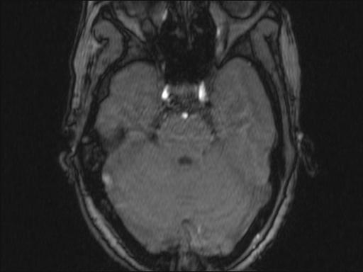 Bilateral carotid body tumors and right glomus jugulare tumor (Radiopaedia 20024-20060 Axial MRA 327).jpg
