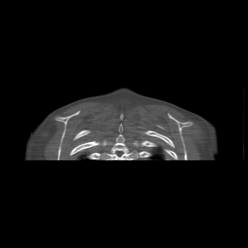 Bilateral chronic posterior shoulder dislocation (Radiopaedia 39213-41452 Coronal bone window 57).jpg