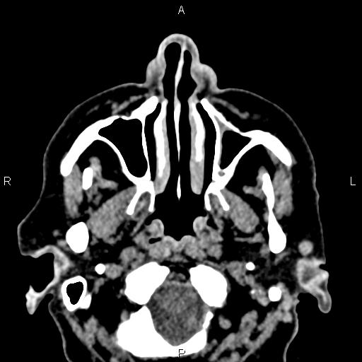 Bilateral enlargement of lacrimal glands - sarcoidosis (Radiopaedia 62627-70921 Axial non-contrast 3).jpg